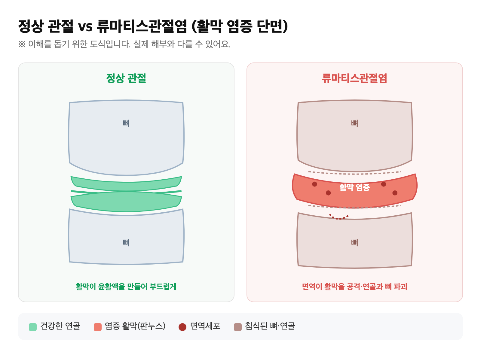 정상 관절과 류마티스관절염의 활막 염증을 비교한 단면 도식 — 정상은 얇고 매끈한 활막, 류마티스는 부풀어 오른 염증 활막(판누스)이 연골과 뼈를 침식