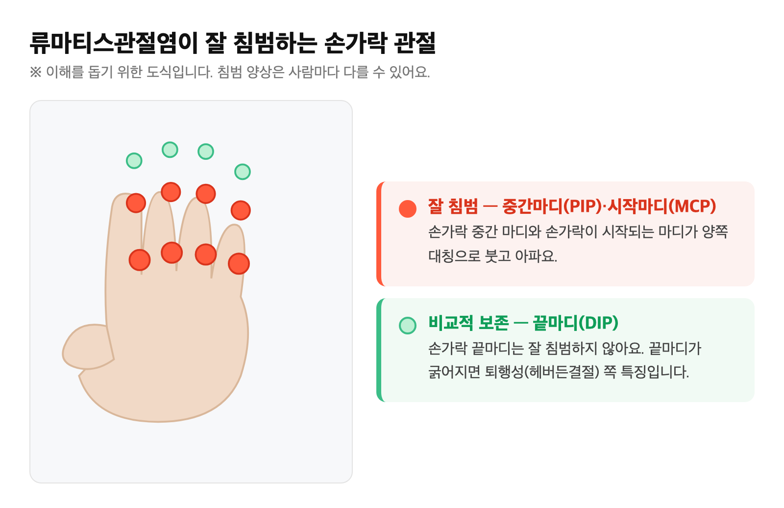 류마티스관절염이 잘 침범하는 손가락 관절 도식 — 시작마디(MCP)와 중간마디(PIP)는 빨강으로 침범, 끝마디(DIP)는 비교적 보존