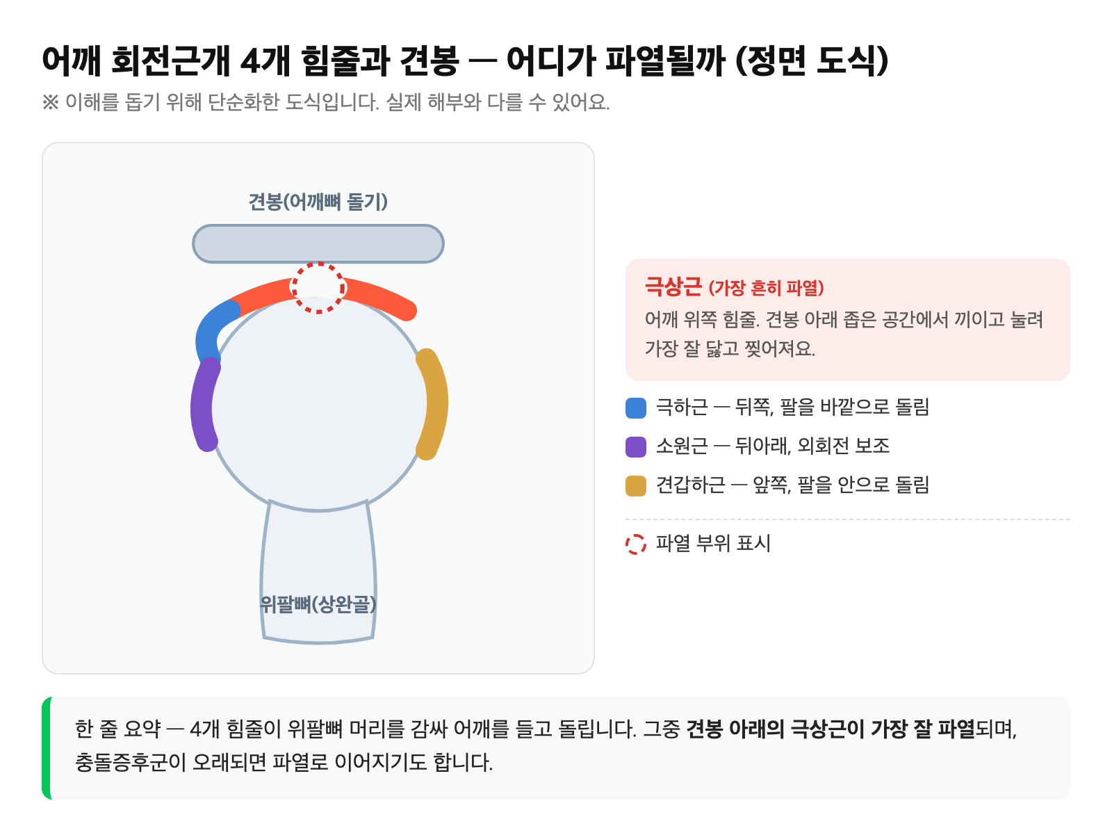 어깨 회전근개 4개 힘줄(극상근·극하근·소원근·견갑하근)과 견봉, 그리고 극상근 힘줄이 파열된 부위를 표시한 도식