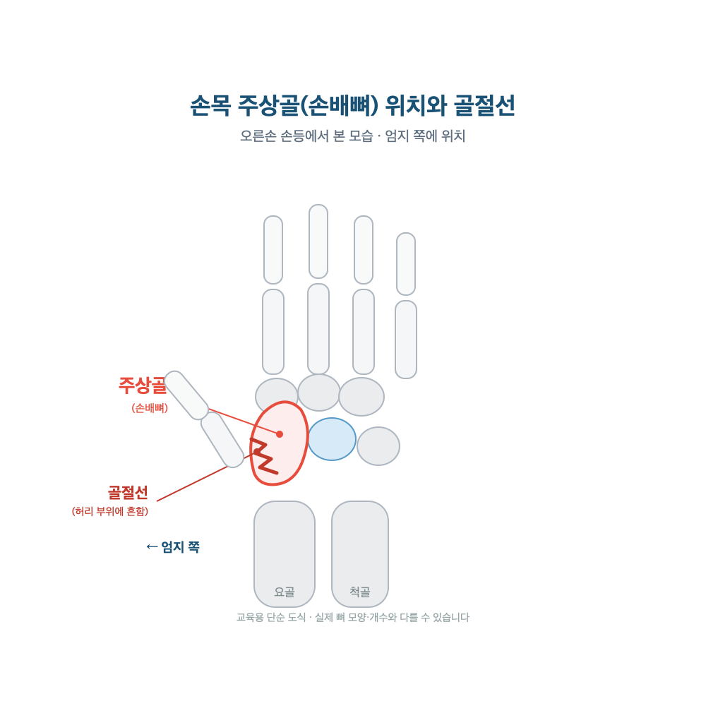 오른손 손등에서 본 주상골(손배뼈)의 위치와, 뼈 허리 부위를 가로지르는 골절선을 단순화한 도식
