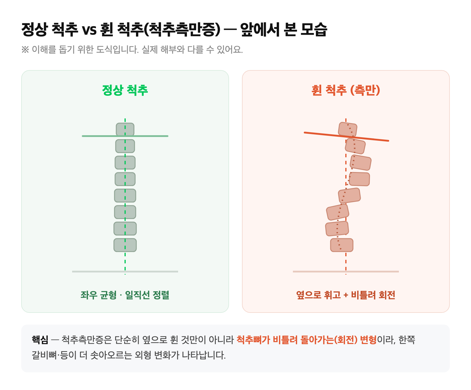정상 척추와 옆으로 휘고 회전한 척추(측만)를 정면에서 비교한 단순 도식