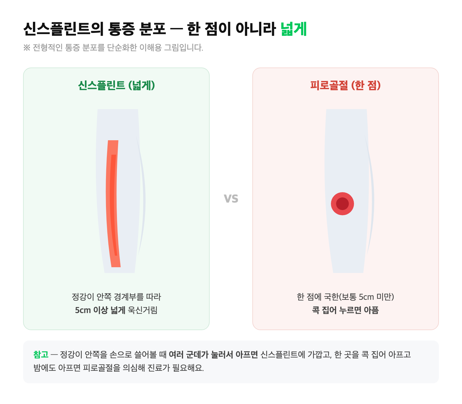 신스플린트는 정강이 안쪽 경계부를 따라 넓은 띠로, 피로골절은 한 점에 국한되어 나타나는 통증 분포를 비교한 다리 그림