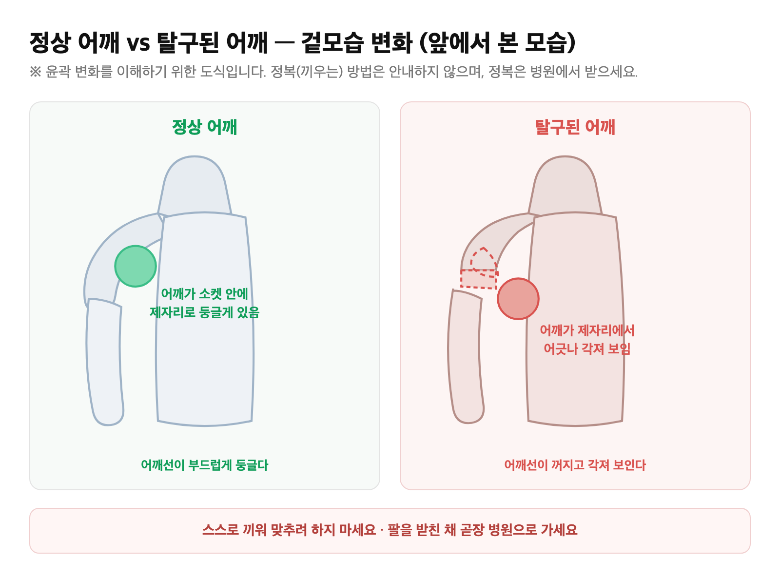 정상 어깨 윤곽과 탈구로 각지게 변형된 어깨 모습 비교 도식