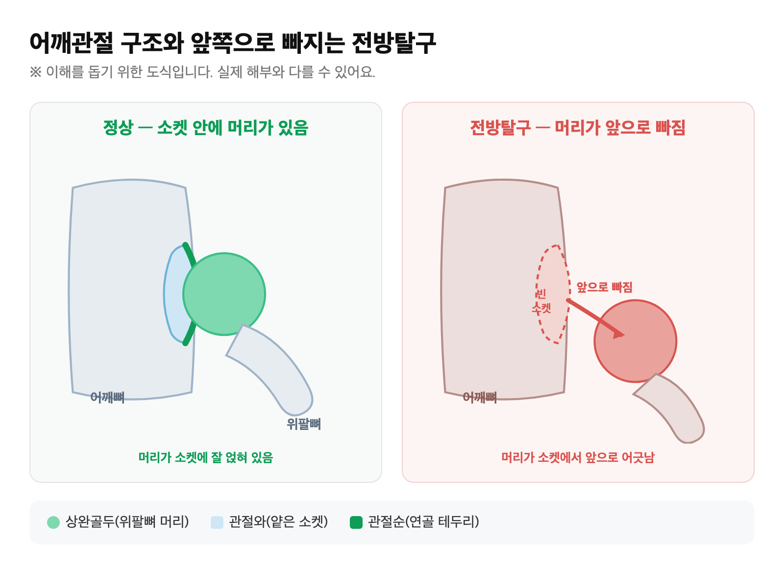 어깨관절 해부 구조와 앞쪽으로 빠지는 전방탈구 도식