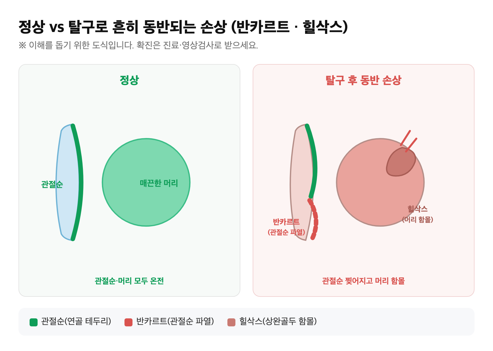 정상 관절순과 반카르트·힐삭스 손상을 비교한 도식