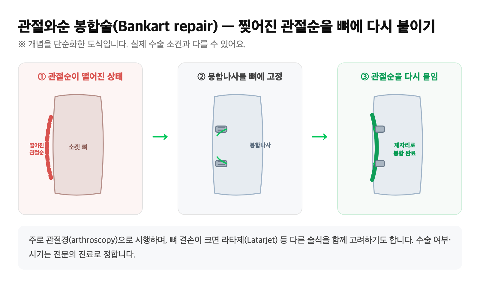 관절와순 봉합술(Bankart repair) 개념도