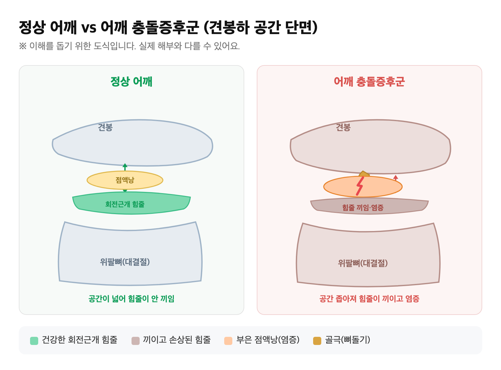 정상 견봉하 공간과, 공간이 좁아져 회전근개 힘줄과 점액낭이 견봉에 끼이고 염증이 생긴 어깨 충돌증후군을 비교한 단면 도식