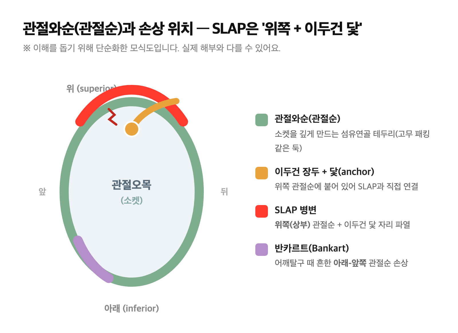 어깨 관절오목과 관절와순의 위치, 위쪽(SLAP)·아래앞쪽(반카르트) 손상 부위, 이두건 장두가 위쪽 관절순에 붙는 닻(anchor)을 표시한 이해용 도식