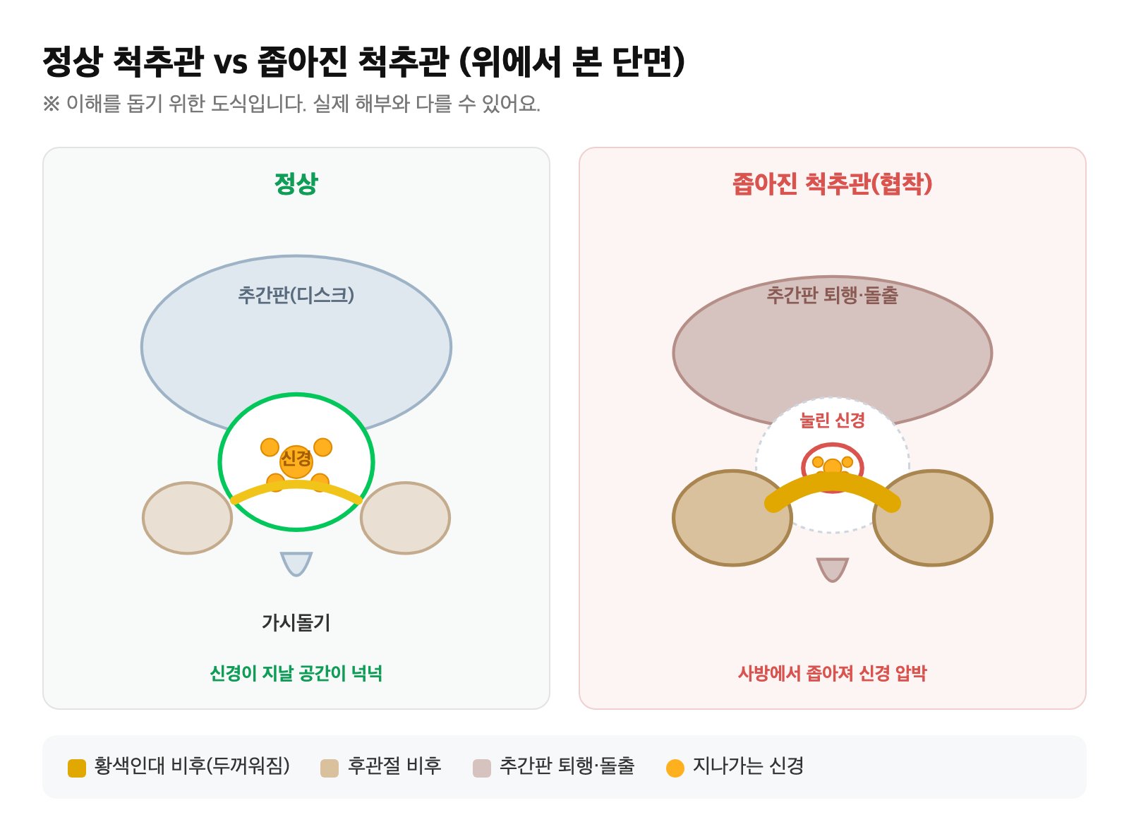 정상 척추관과 좁아진 척추관(협착) 단면을 위에서 본 비교 도식 — 후관절 비후·황색인대 비후·추간판 퇴행으로 신경 통로가 좁아지는 모습