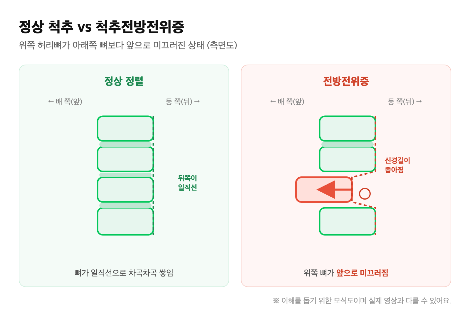 정상 척추와 척추전방전위증을 측면에서 비교한 모식도 — 위쪽 허리뼈가 앞으로 미끄러져 신경길이 좁아진 모습
