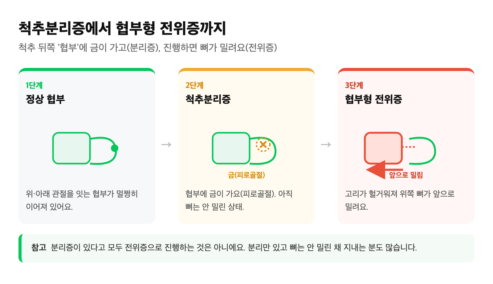 정상 협부에서 척추분리증(협부 피로골절), 협부형 전위증으로 진행하는 3단계 도식