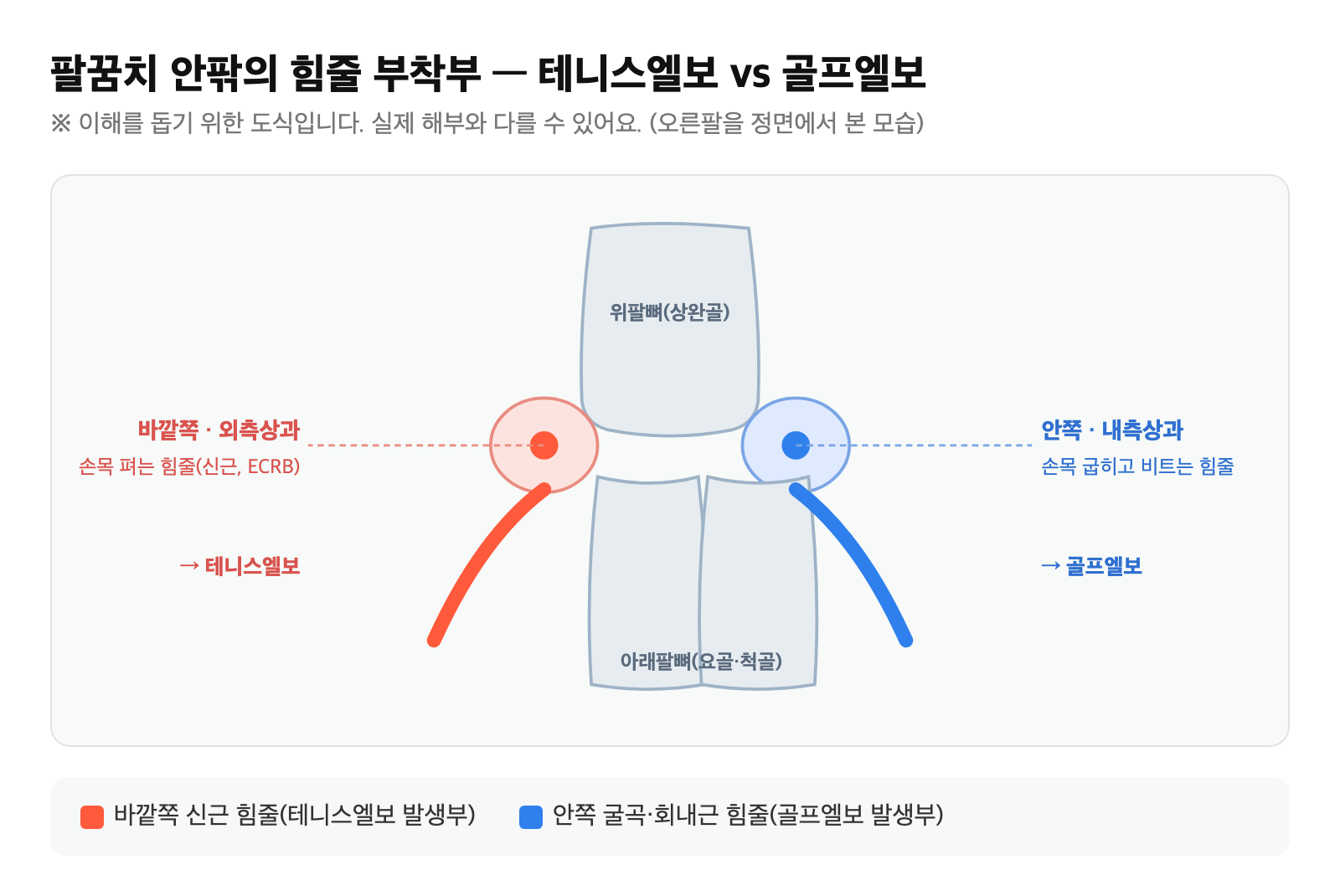 팔꿈치 바깥쪽(외측상과·손목 펴는 힘줄)과 안쪽(내측상과·손목 굽히는 힘줄)의 부착부를 표시한 도식 — 테니스엘보와 골프엘보가 생기는 위치 비교