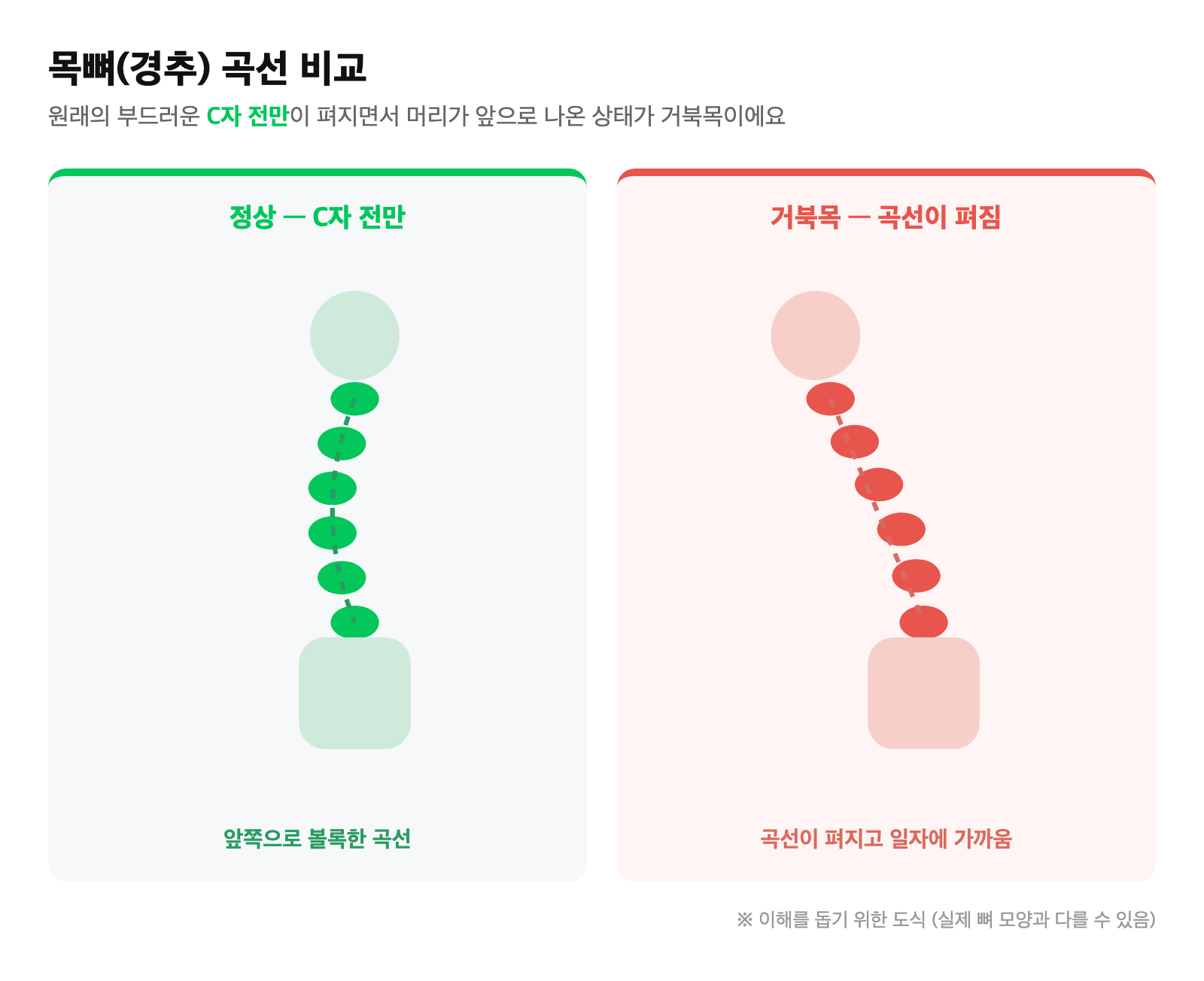 정상 경추의 C자 전만 곡선과 곡선이 펴진 거북목을 비교한 옆모습 도식