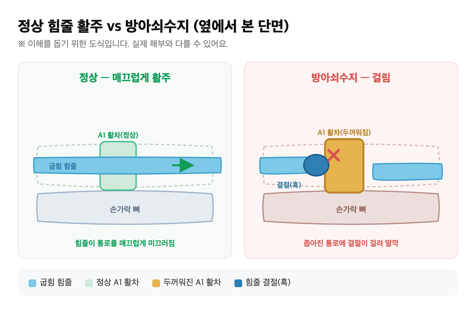 정상적으로 힘줄이 통로를 미끄러지는 모습과, 두꺼워진 A1 활차에 힘줄 결절이 걸린 방아쇠수지를 비교한 도식