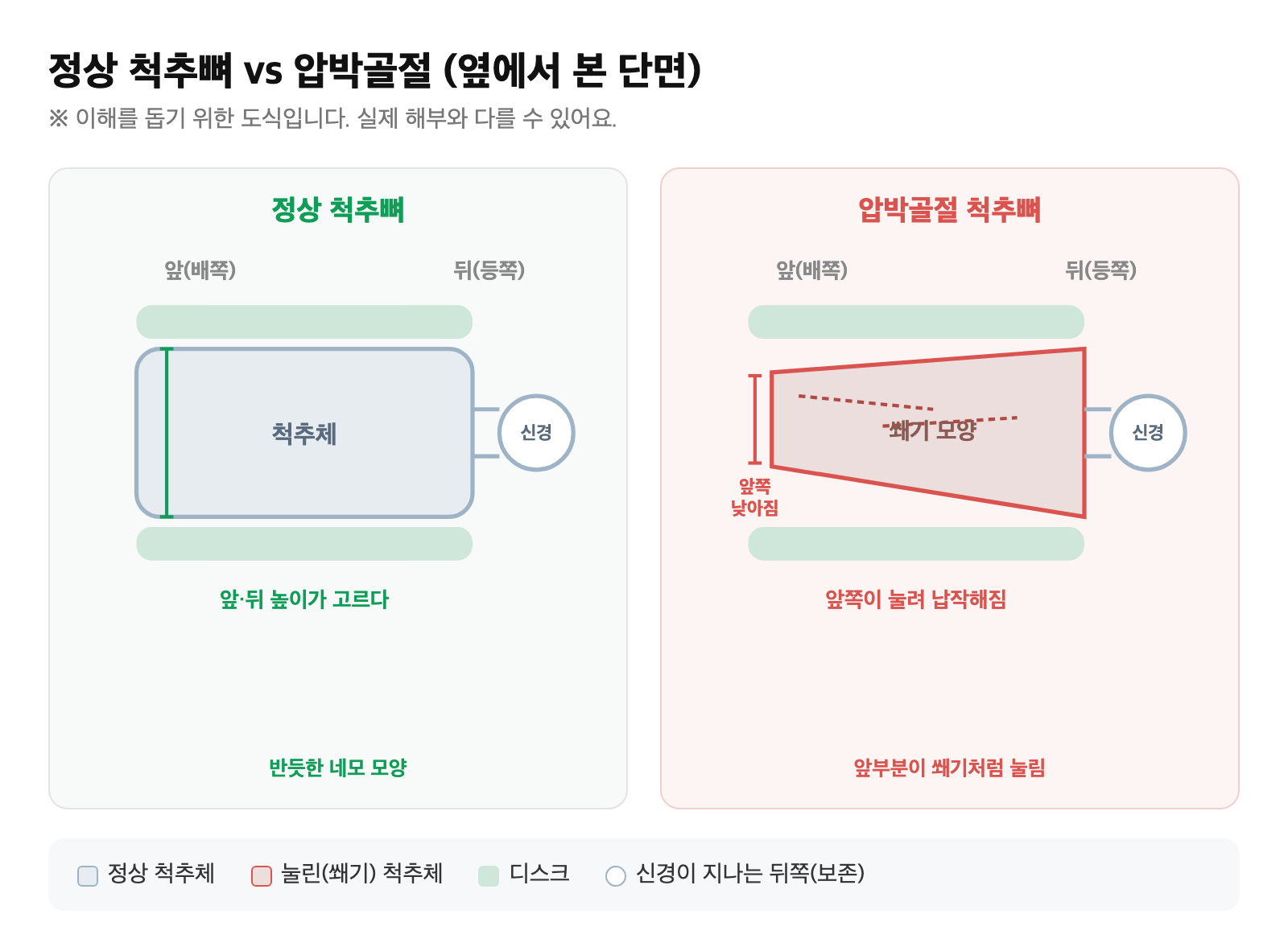 정상 척추체와, 앞부분이 쐐기 모양으로 눌려 납작해진 압박골절 척추체의 단면을 비교한 도식