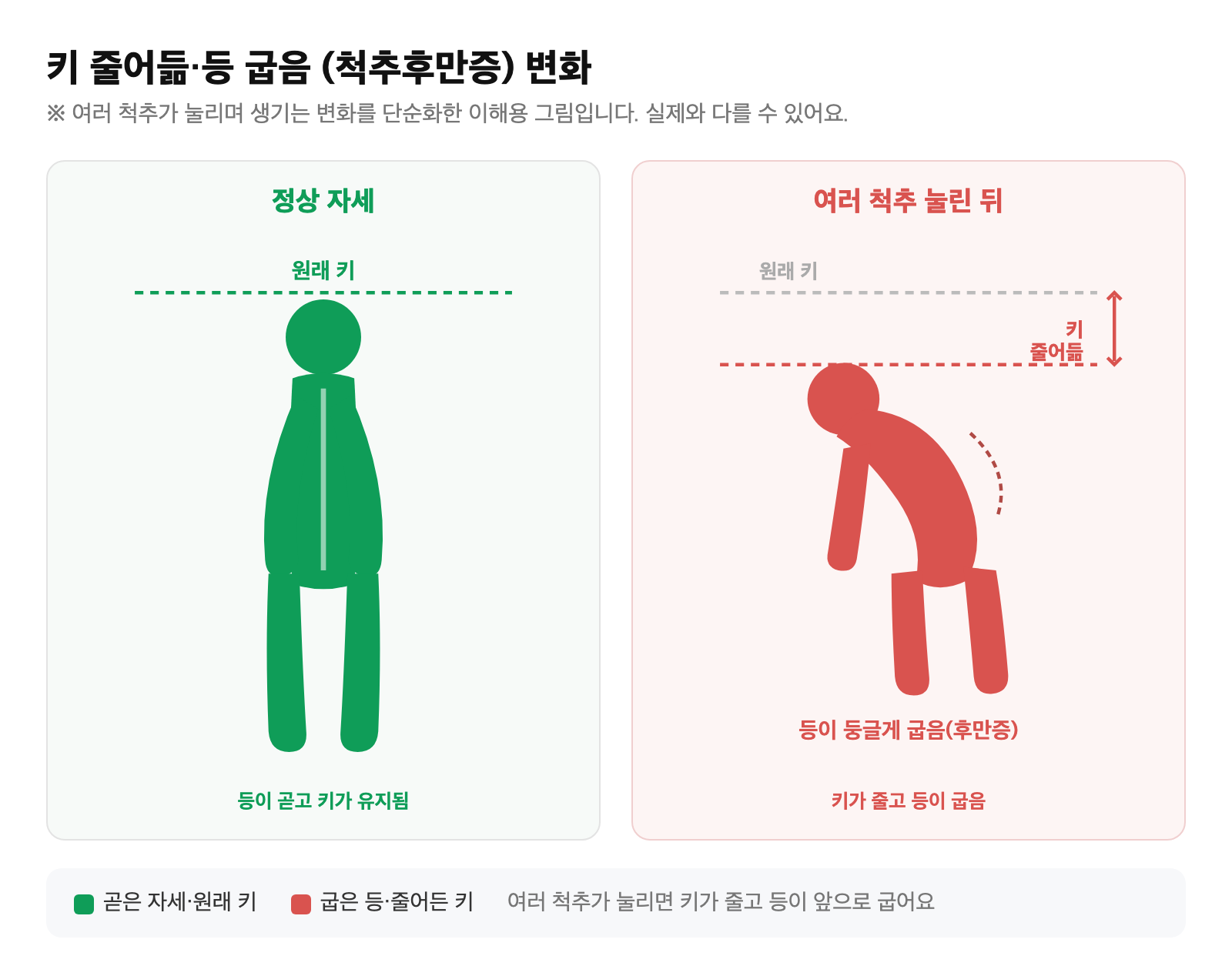 척추가 여러 군데 눌리며 키가 줄고 등이 앞으로 굽는 척추후만증 변화를 단순화한 일러스트